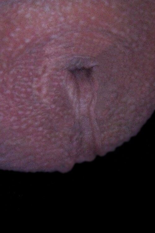 Free porn pics of Before Sex Change: Penectomy Scrotum 1 of 1 pics